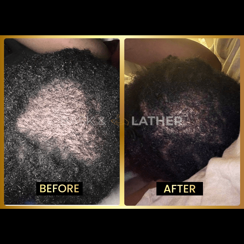 Scalp Stimulator- 3 Month Supply