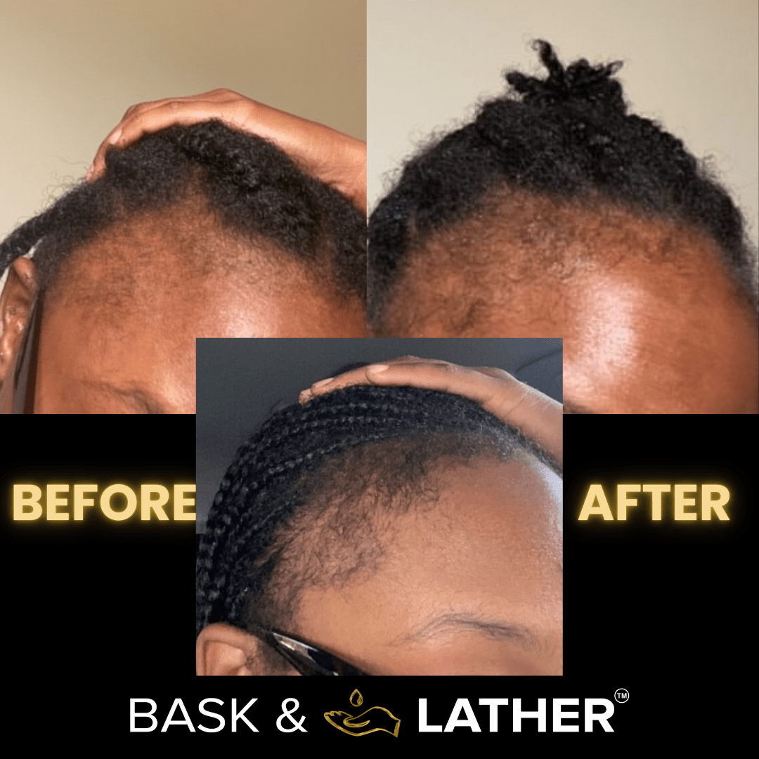 Scalp Stimulator | Hair Growth Oil