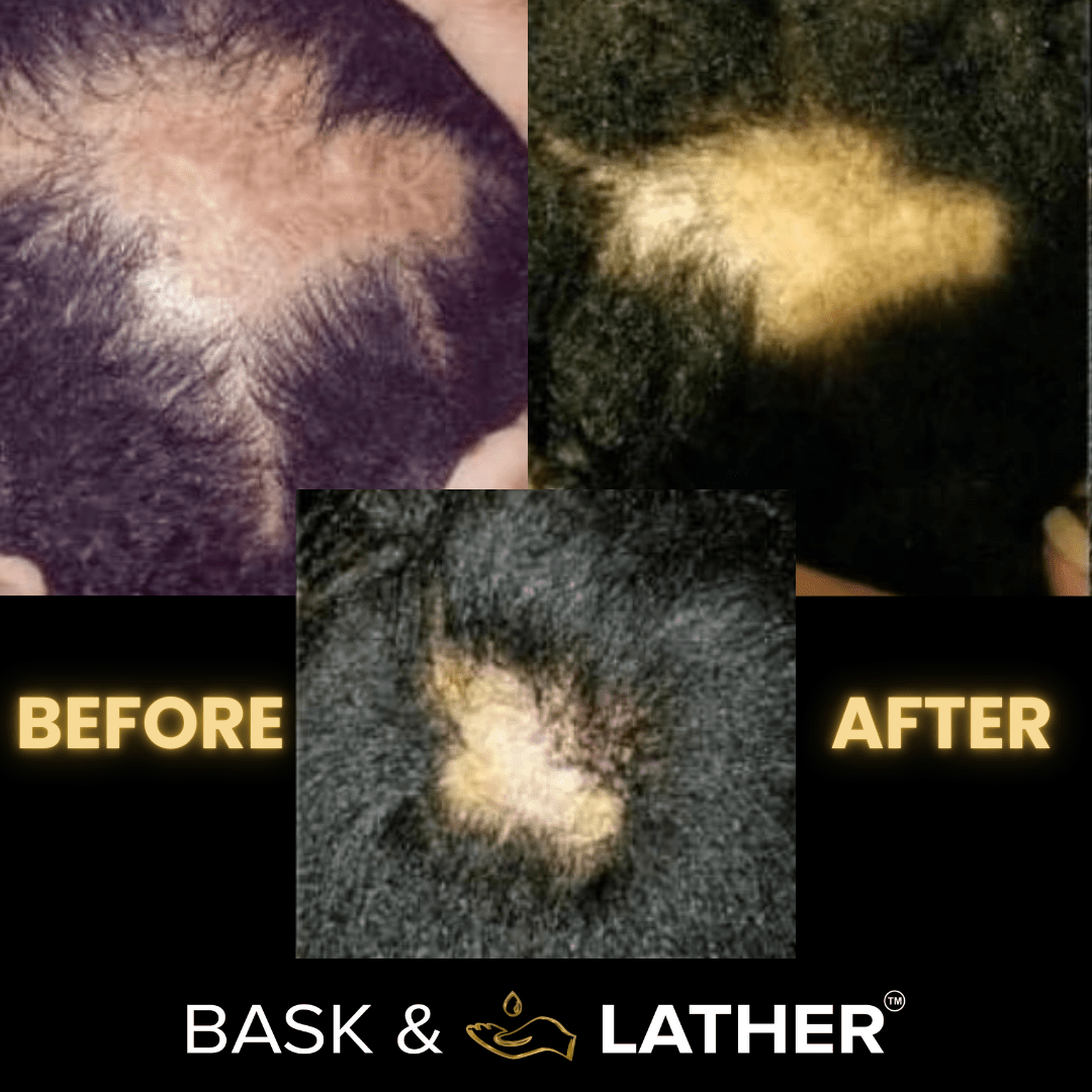 Scalp Stimulator | Hair Growth Oil